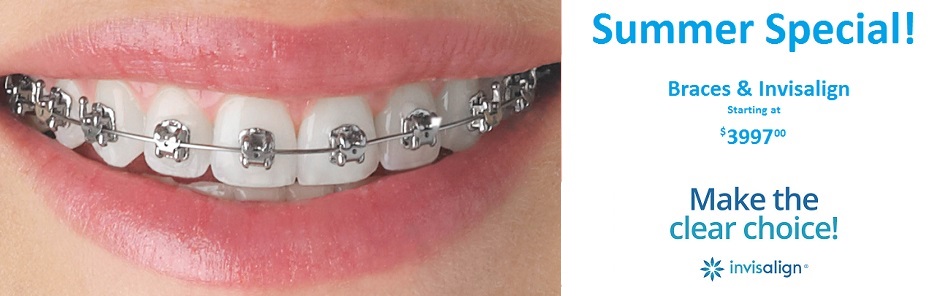 Summer Special on Braces and Invisalign